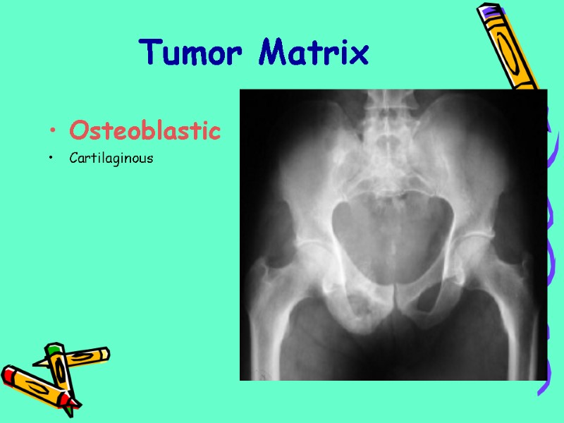 Tumor Matrix Osteoblastic Cartilaginous